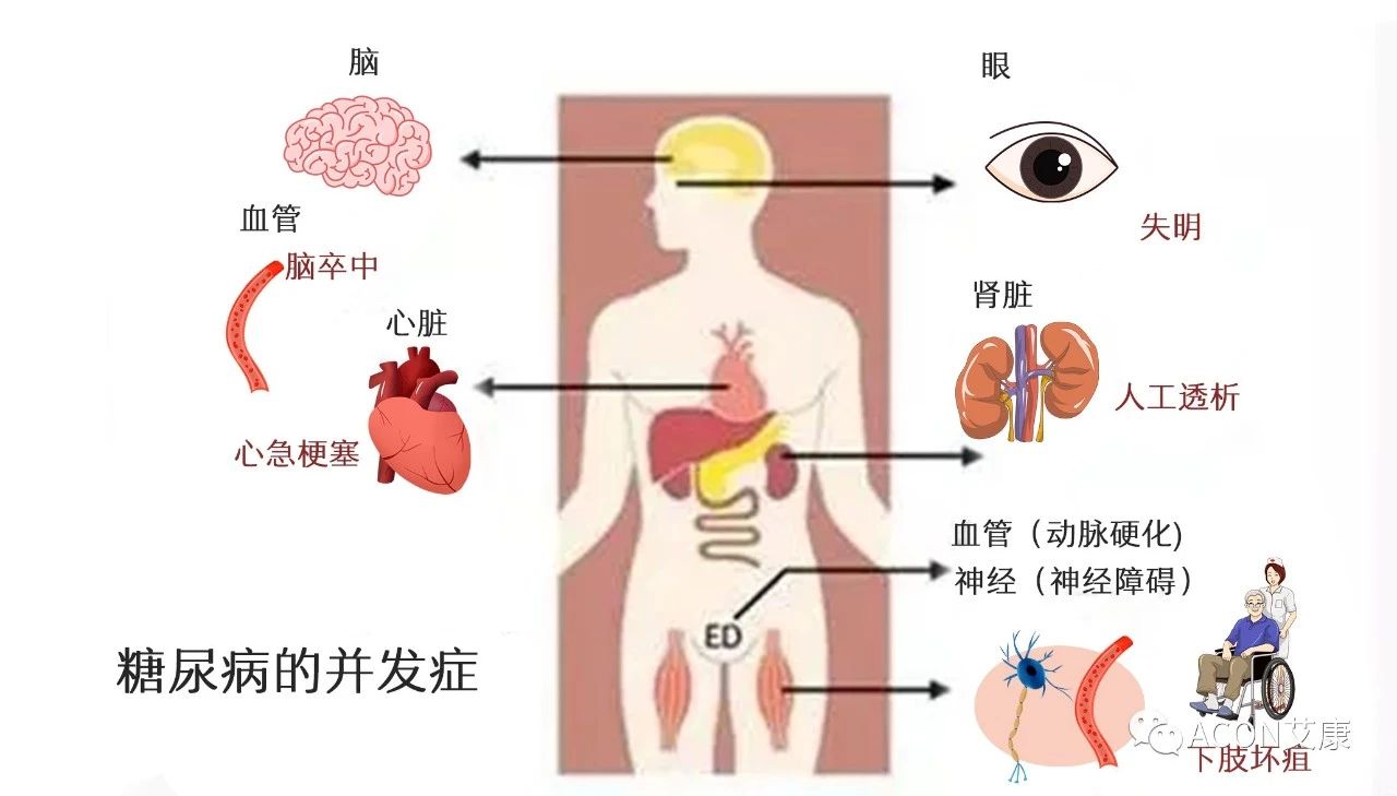 爆上热搜，因爆发型糖尿病进入ICU，有哪些教训值得我们汲取